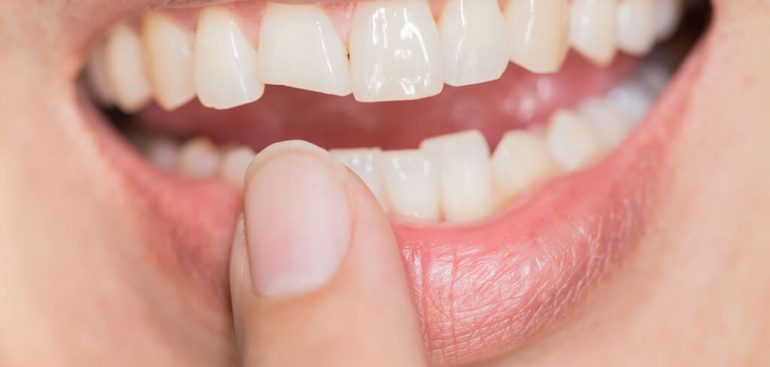門牙斷裂-門牙缺角-沈志容醫師