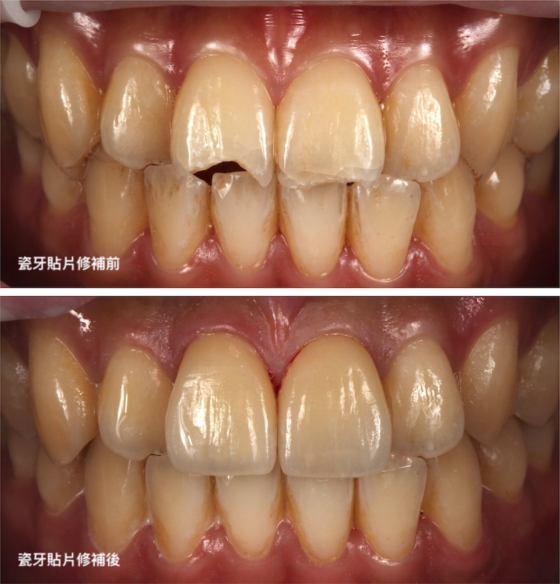 門牙斷裂-門牙斷掉-瓷牙貼片修補前後比較-沈志容醫師-桃園