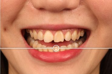 門牙缺角影響美觀嗎？推薦用陶瓷貼片修復