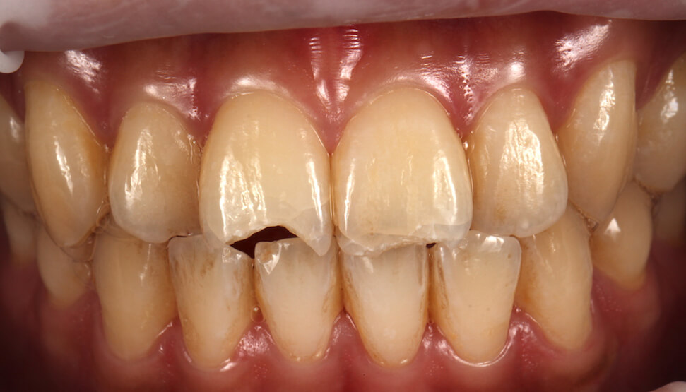 門牙斷裂-門牙斷掉-瓷牙貼片修補前-缺一角-門牙裂痕-沈志容醫師-桃園