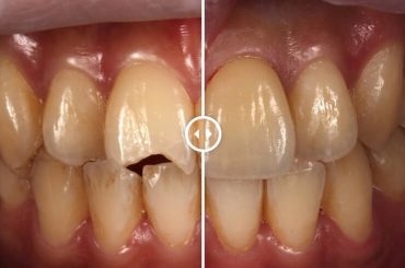 門牙斷裂補牙處理外新選擇：陶瓷貼片修補斷掉門牙更自然美觀