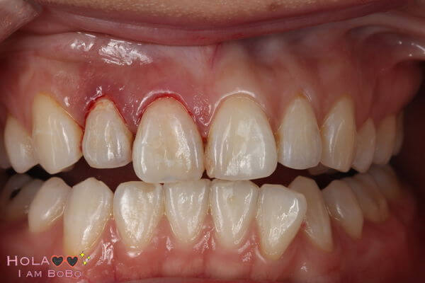 牙齒黃-陶瓷貼片-DSD微笑設計-牙齦整形手術後-門牙外觀-主播王暐婷-沈志容醫師-桃園