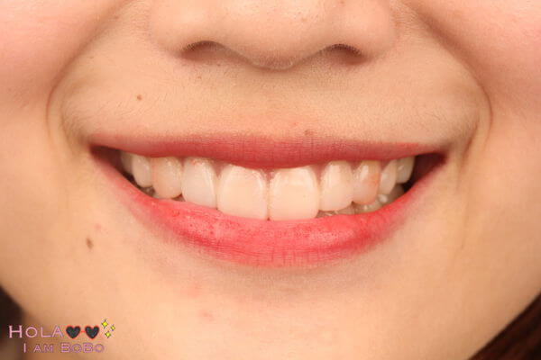 牙齒黃-牙齒美白-DSD微笑設計-陶瓷貼片模擬試戴-主播王暐婷-沈志容醫師-桃園