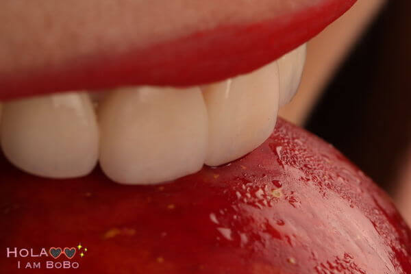 牙齒黃-牙齒美白-陶瓷貼片術後-上排門牙藝術照-2-沈志容醫師-桃園