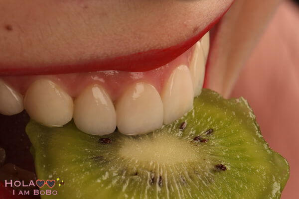 牙齒黃-牙齒美白-陶瓷貼片術後-上排門牙藝術照-4-沈志容醫師-桃園