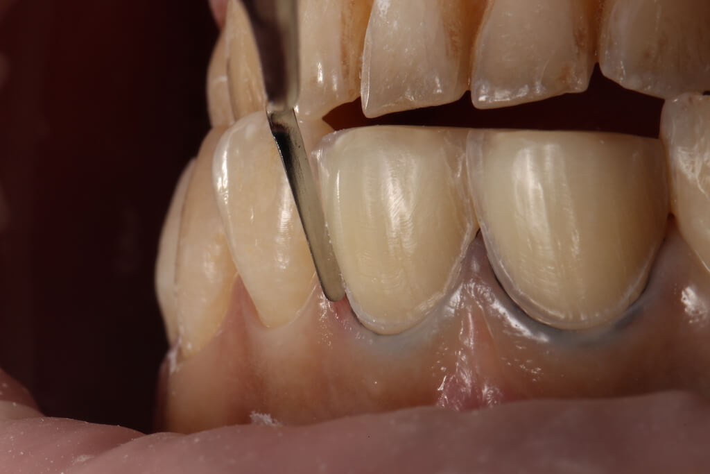 瓷牙貼片免磨牙-顯微鏡微創磨牙