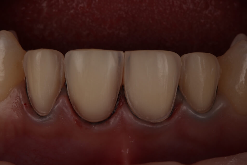 瓷牙貼片磨牙-顯微鏡微創磨牙下的牙齒