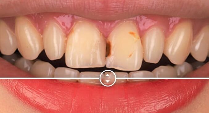 門牙蛀牙重覆補牙-陶瓷貼片修補笑容前後比對