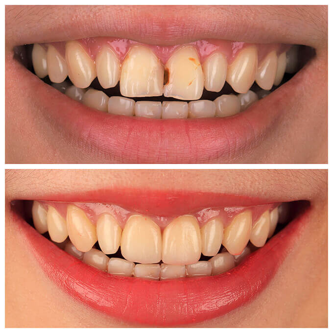 門牙蛀牙-門牙貼片-牙齒貼片前後笑容比較-桃園陶瓷貼片推薦-沈志容醫師