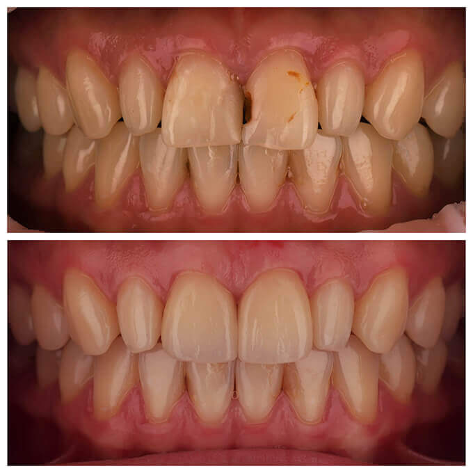 門牙蛀牙-門牙貼片-牙齒貼片前後比較-桃園陶瓷貼片推薦-沈志容醫師