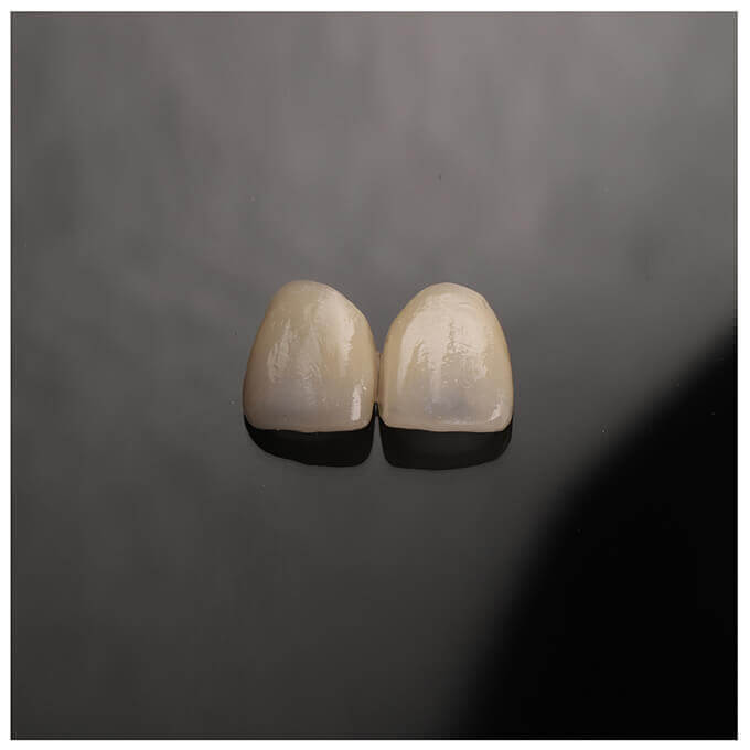 門牙蛀牙-陶瓷貼片-桃園-推薦-沈志容醫師