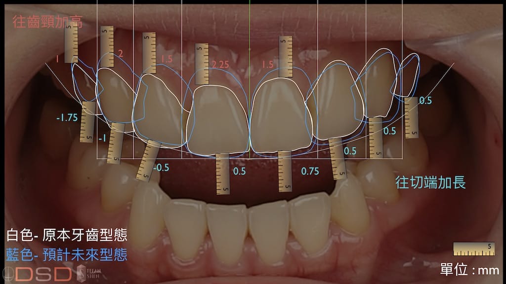 DSD數位微笑設計如何進行-牙齒形狀分析