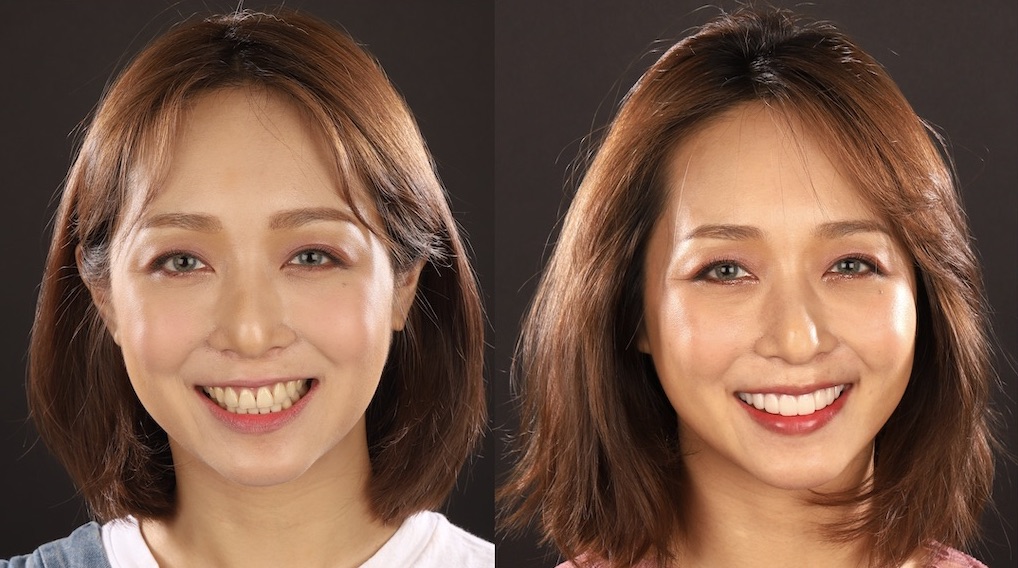 DSD數位微笑設計如何進行-試戴瓷牙貼片前後對比
