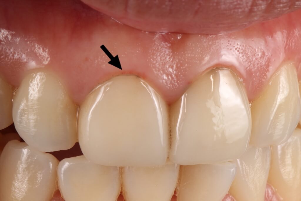 非使用牙科專用顯微鏡-陶瓷貼片-牙齦邊緣染色
