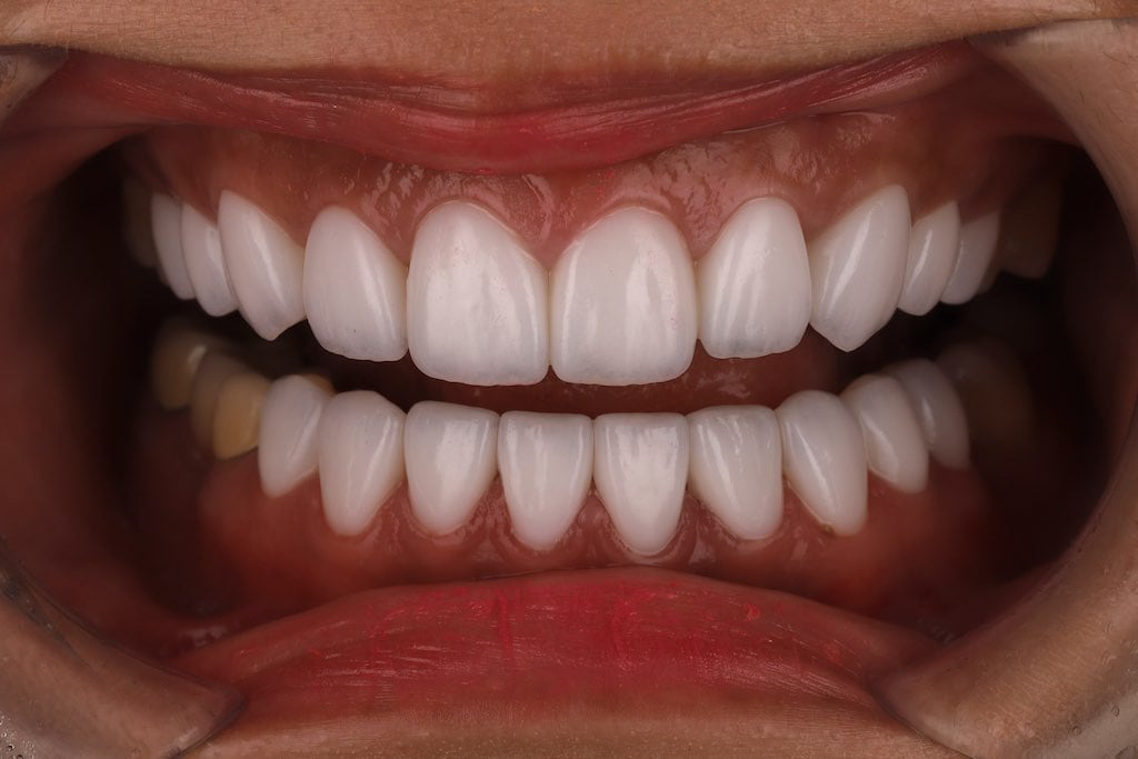 陶瓷貼片-全瓷貼片-桃園牙齒美白案例-沈志容醫師