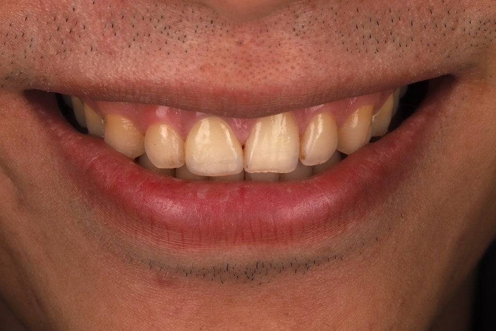 根管治療變色-門牙斷裂-門牙缺角-全瓷冠修復後-桃園牙齒美白案例-沈志容醫師