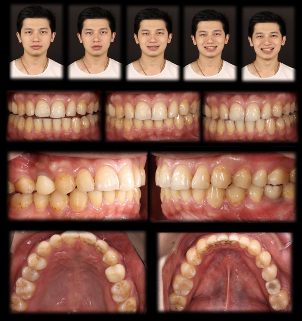 沈志容醫師的瓷牙貼片親身經歷-DSD數位微笑分析前需拍攝各角度笑容與牙齒照