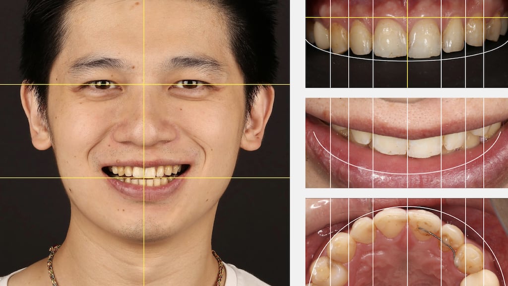 沈志容醫師的瓷牙貼片親身經歷-使用DSD數位微笑設計分析牙齒位置唇型與臉型比例