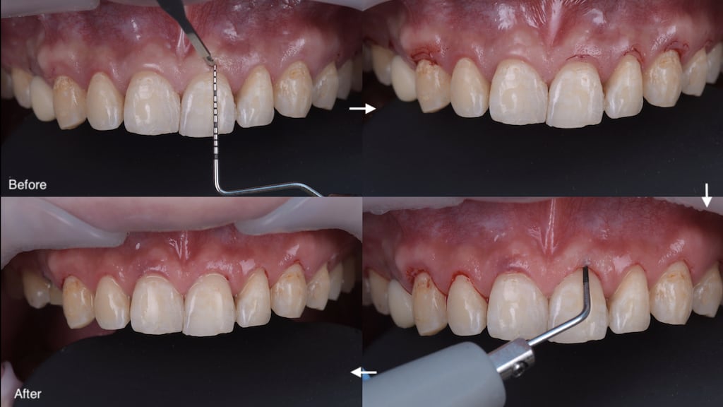 沈志容醫師的瓷牙貼片親身經歷-使用雷射與超音波進行免縫合的微創牙齦手術