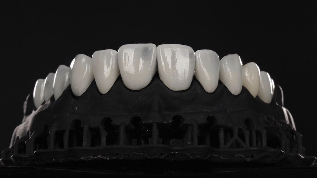 沈志容醫師的瓷牙貼片親身經歷-將瓷牙貼片置於牙齒模型確認密合度與對稱性