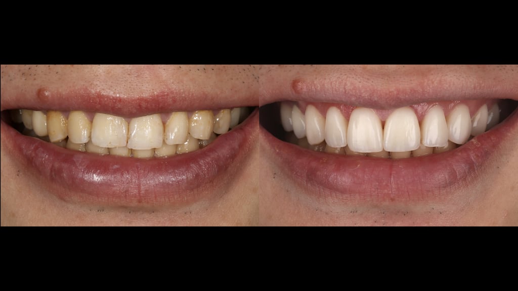 沈志容醫師的瓷牙貼片親身經歷-瓷牙貼片治療前後比較圖
