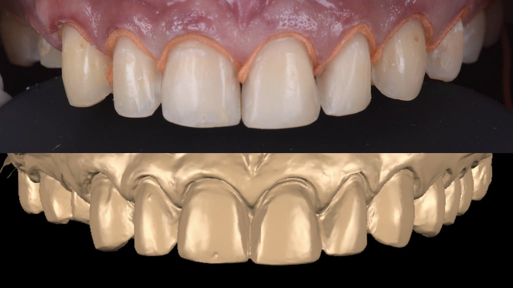 沈志容醫師的瓷牙貼片親身經歷-經顯微微創修磨後的牙齒與掃描後的數位模型