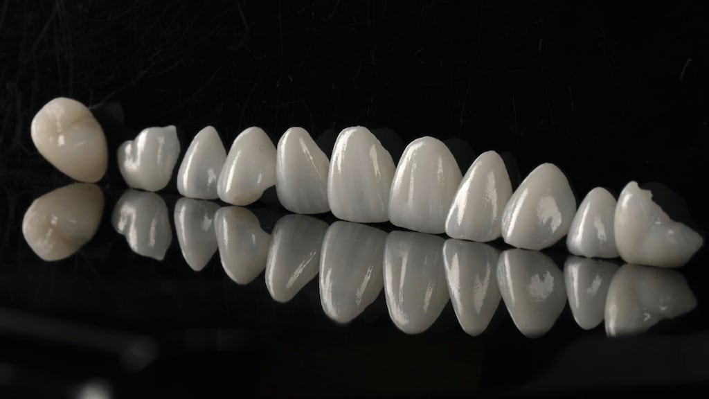 沈志容醫師的瓷牙貼片親身經歷-製作完成之瓷牙貼片與全瓷冠一字排開