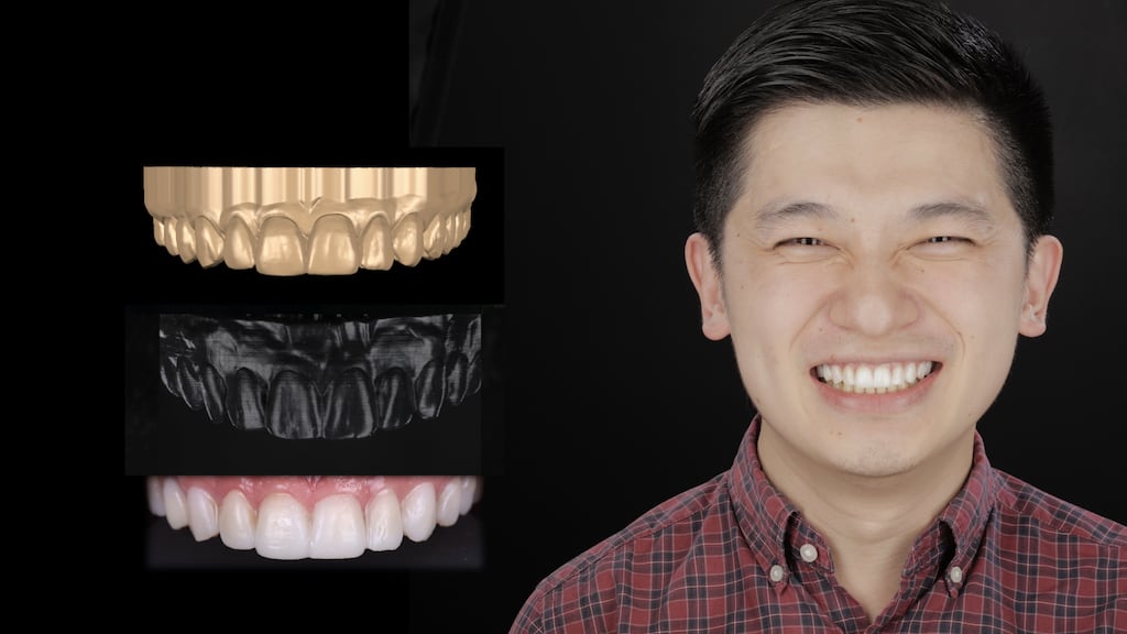 沈志容醫師的瓷牙貼片親身經歷-透過DSD數位微笑分析流程試戴笑容