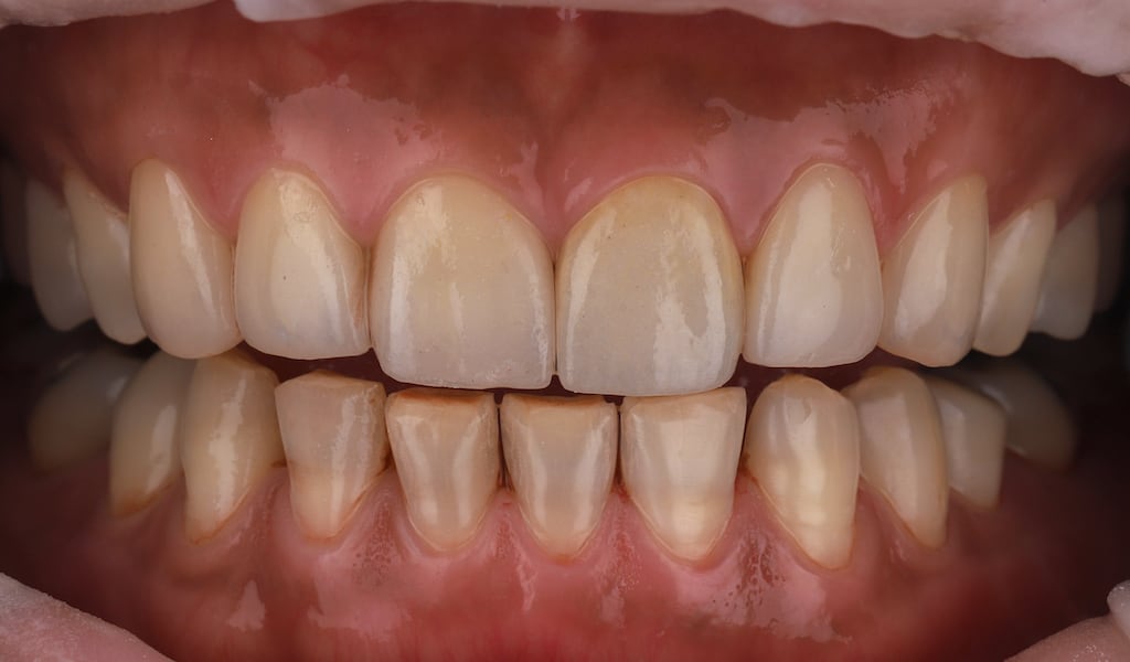 陶瓷貼片-四環黴素牙齒-牙齒染色-上排牙貼片療程後-沈志容醫師-桃園
