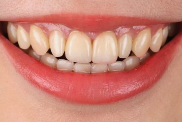 瓷牙貼片-全瓷冠-牙齒美白-推薦-桃園-沈志容醫師