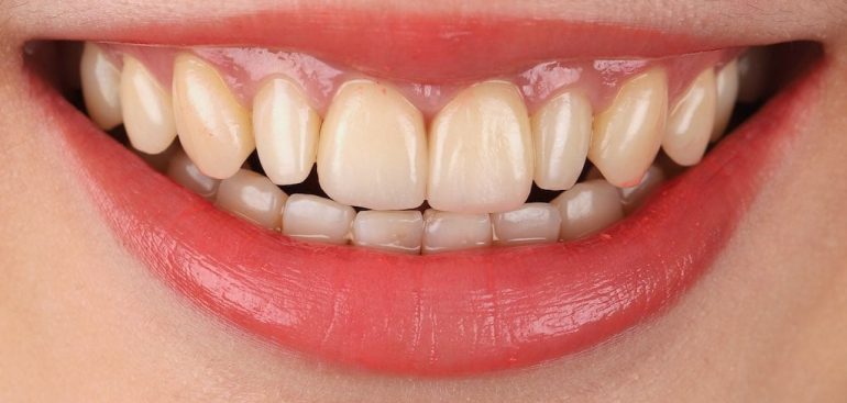 瓷牙貼片-全瓷冠-牙齒美白-推薦-桃園-沈志容醫師