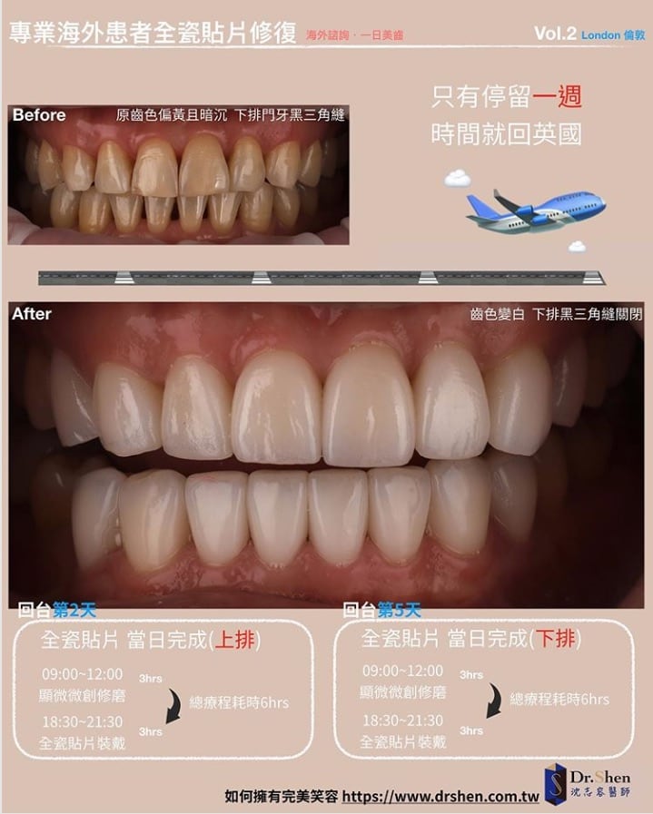 前牙美學專家-沈志容醫師推薦案例-倫敦來回一周完成-Instagram1