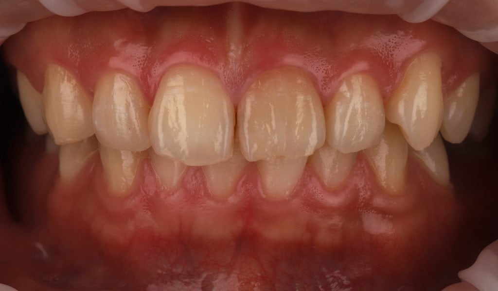 陶瓷貼片-全瓷冠-門牙變黑-牙齒貼片療程前-沈志容醫師-桃園