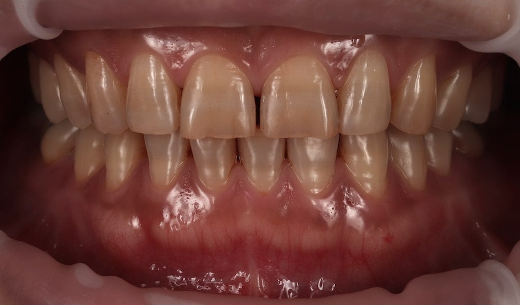陶瓷貼片-四環黴素牙齒-牙齒染色-牙貼片療程前-沈志容醫師-桃園