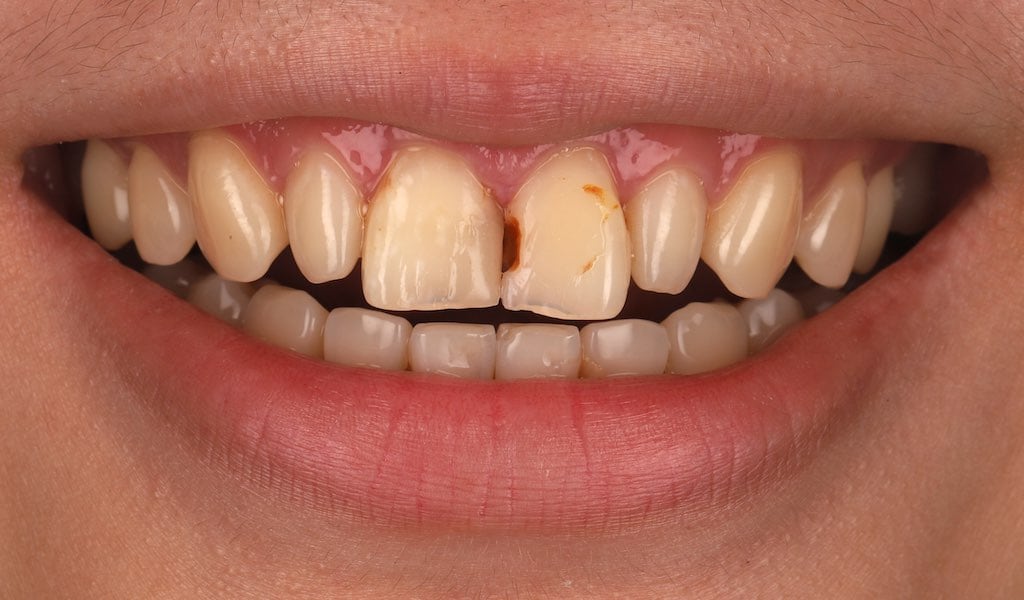 陶瓷貼片-門牙蛀牙-門牙邊緣破損-牙貼片療程前-沈志容醫師-桃園