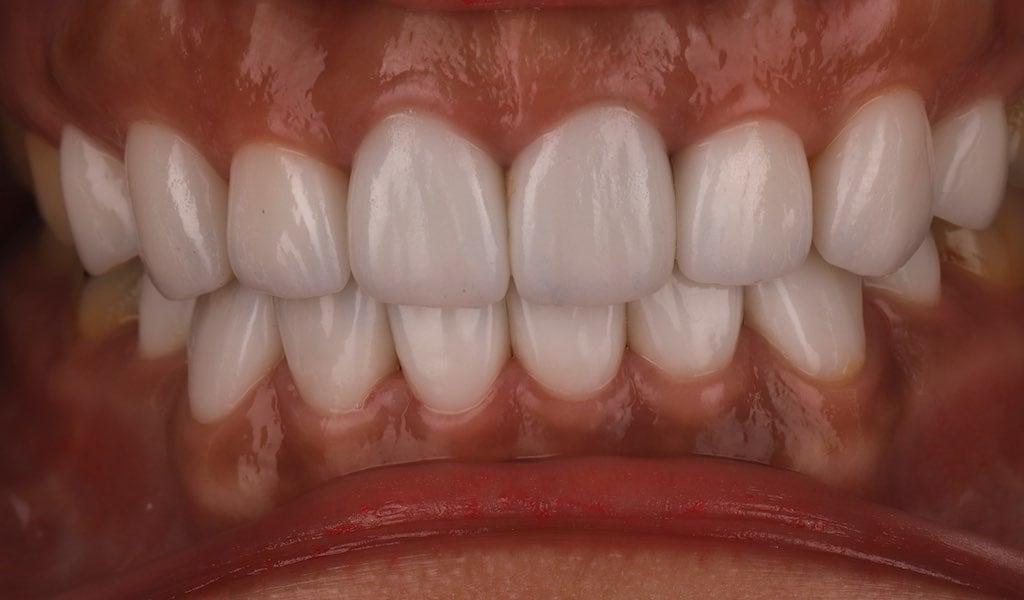瓷牙貼片-門牙全瓷冠-牙齒貼片療程後-一日美齒-沈志容醫師-桃園