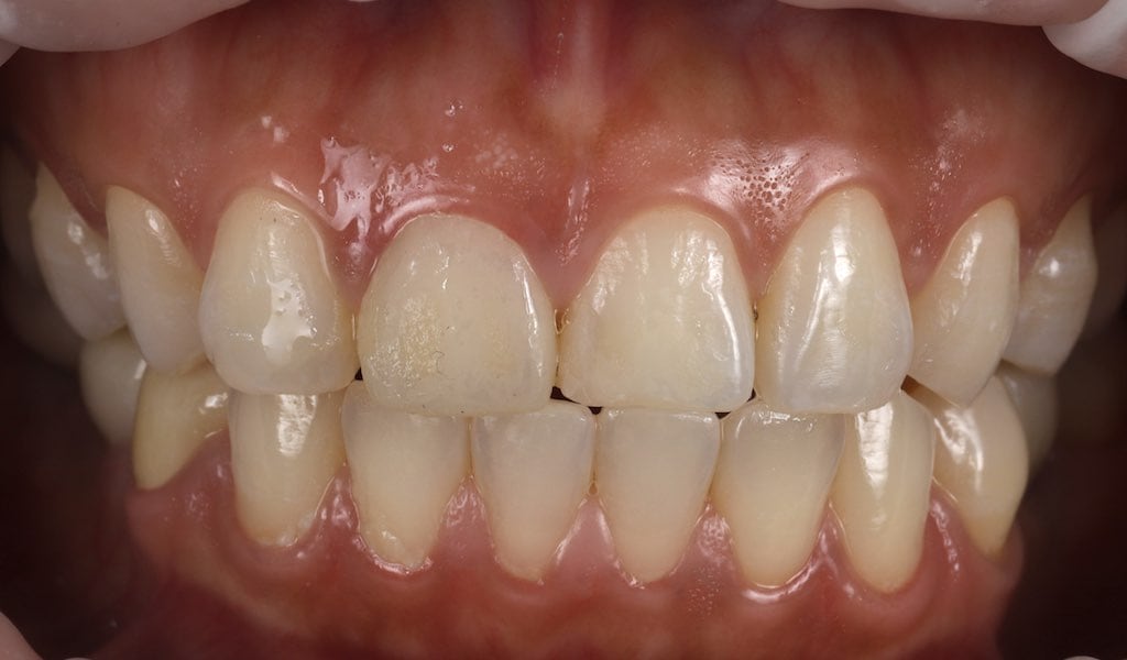 瓷牙貼片-臨時假牙-牙齒貼片療程中-沈志容醫師-桃園