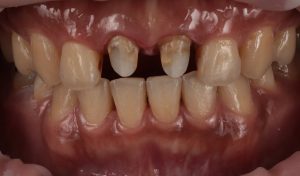 瓷牙貼片-傳統假牙-拆除假牙-牙齒貼片療程中-一日美齒-沈志容醫師-桃園