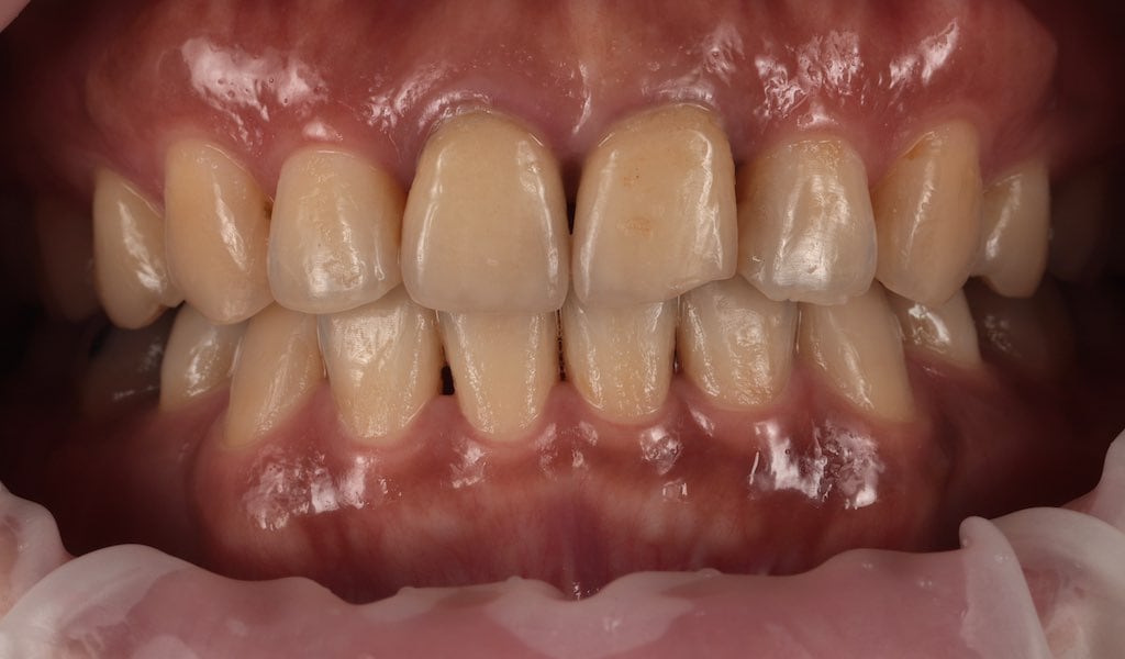 瓷牙貼片-傳統假牙-假牙破損-黑三角縫-牙齒貼片療程前-沈志容醫師-桃園