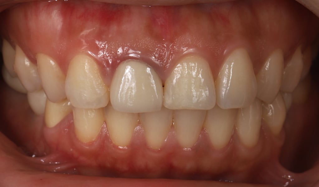 瓷牙貼片-笑露牙齦-牙齒貼片療程前-假牙變黑-沈志容醫師-桃園