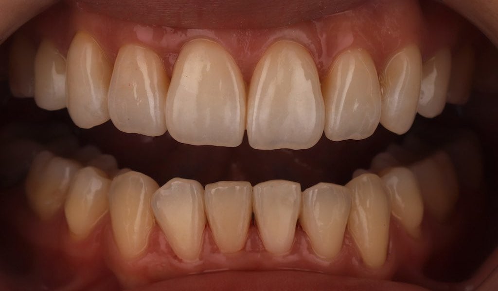 瓷牙貼片-完成牙齒矯正-牙貼片療程後-沈志容醫師-桃園