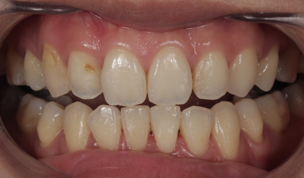 瓷牙貼片-完成牙齒矯正-牙貼片療程前-沈志容醫師-桃園