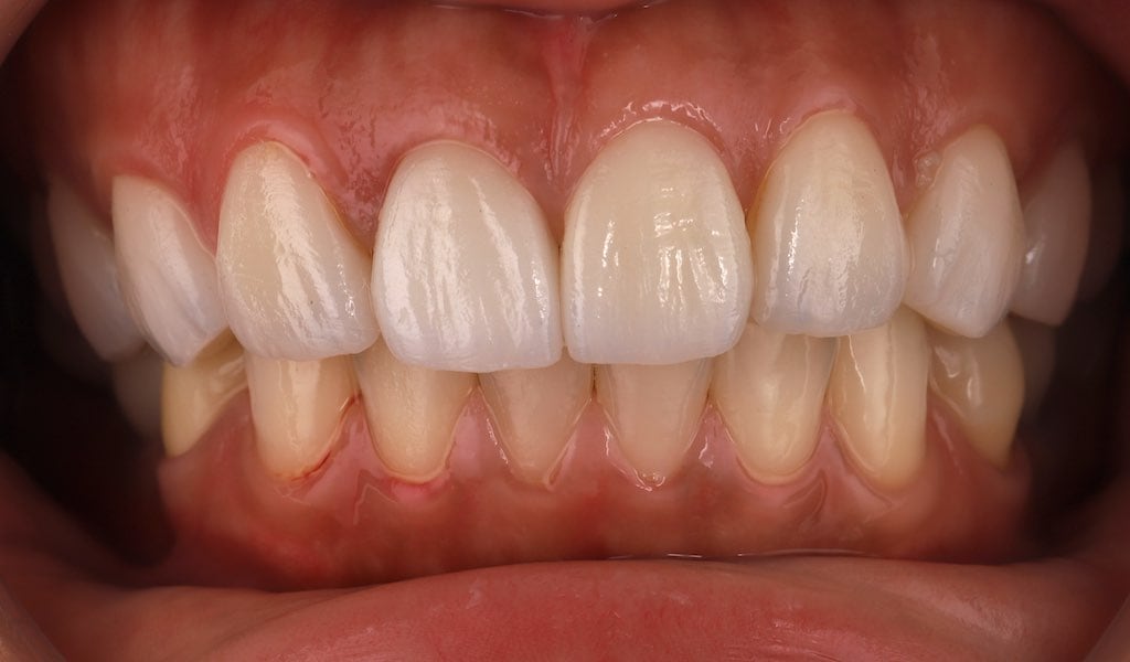 瓷牙貼片-全瓷冠-牙齒貼片療程後-上排前牙-沈志容醫師-桃園