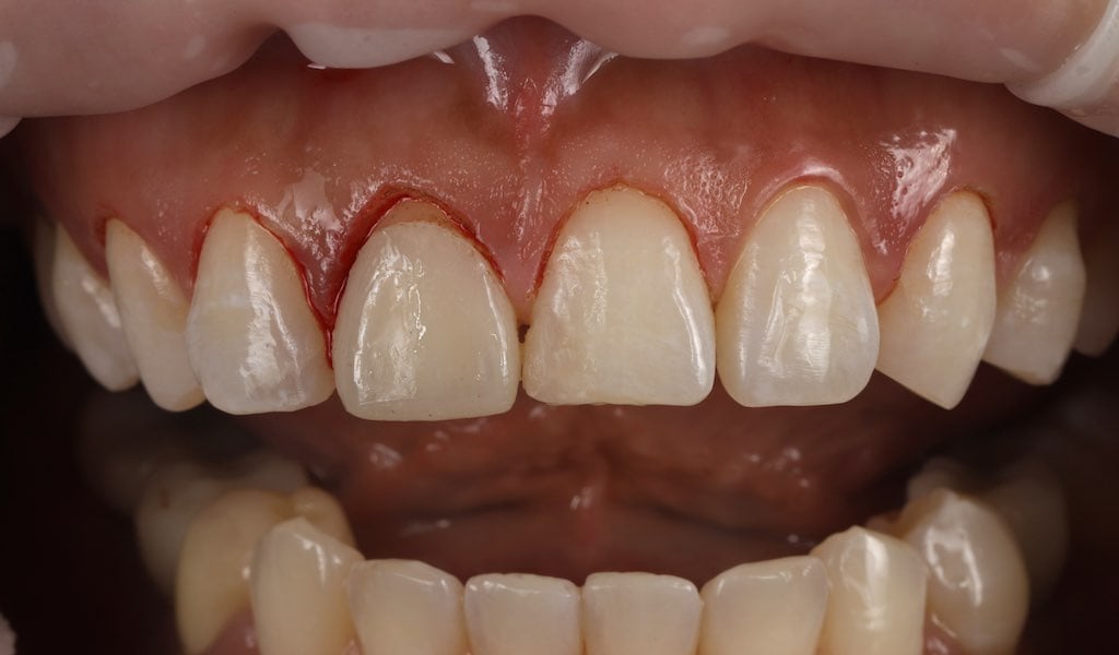 瓷牙貼片-雷射牙齦-牙齒貼片療程中-沈志容醫師-桃園