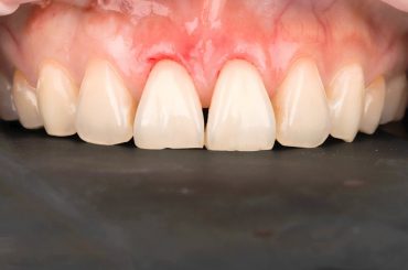 美女部落客克萊兒的牙齒美白心得-part 3.牙冠增長術