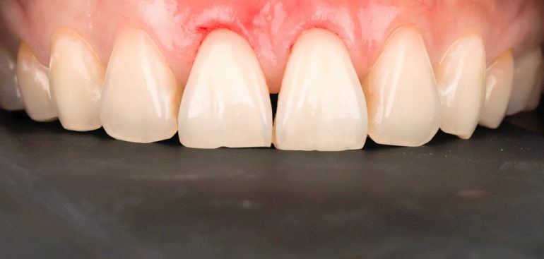 前牙美學專家-沈志容醫師推薦案例-網紅克萊兒牙齒美白全記錄-做完牙冠增長術-用雷射所以不會流血