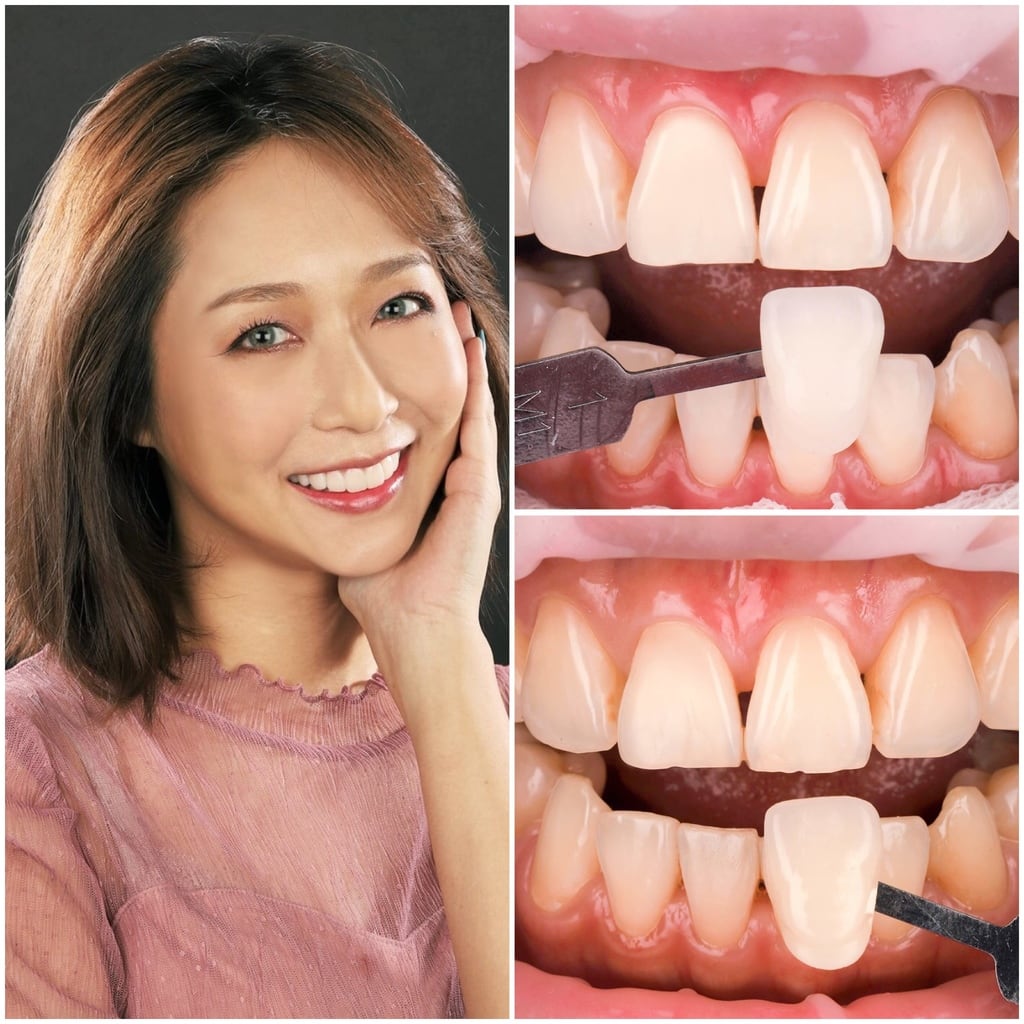 前牙美學專家-沈志容醫師推薦案例-網紅克萊兒牙齒美白全記錄-冷光美白