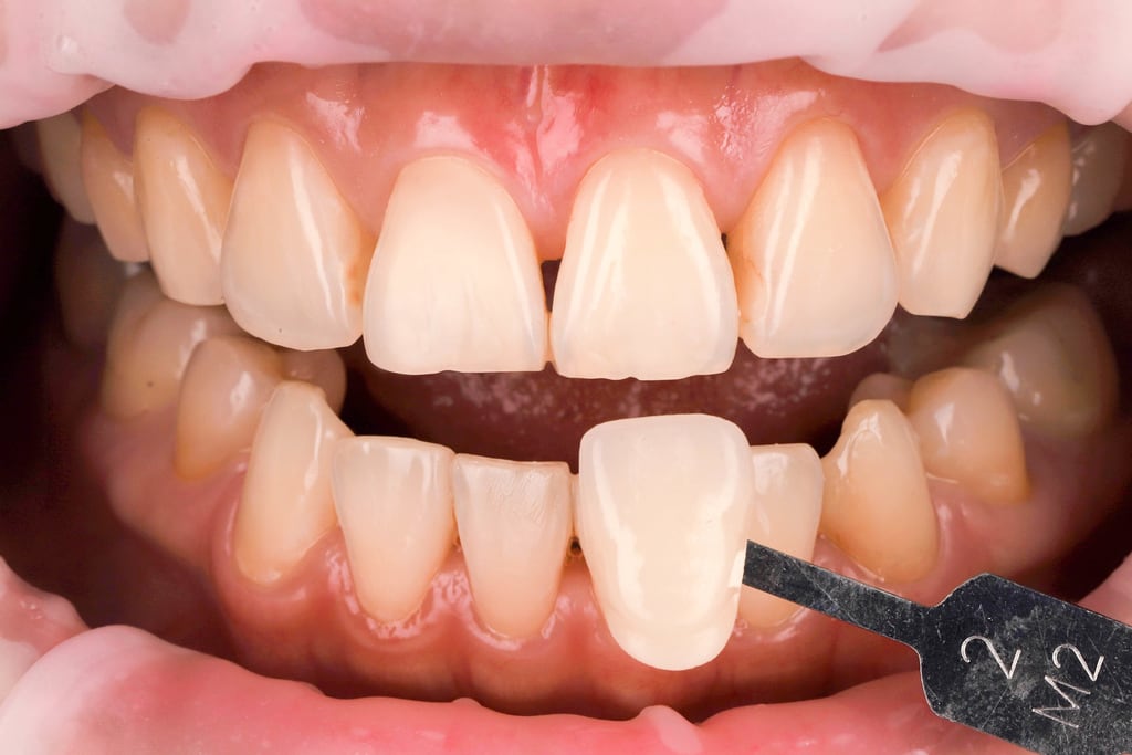 前牙美學專家-沈志容醫師推薦案例-網紅克萊兒牙齒美白全記錄-冷光美白前牙齒是M2