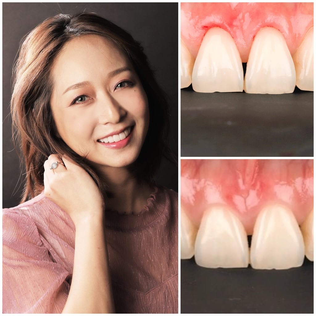 前牙美學專家-沈志容醫師推薦案例-網紅克萊兒牙齒美白全記錄-牙冠增長術