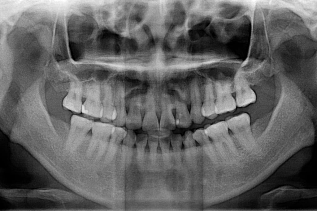 前牙美學專家-沈志容醫師推薦案例-網紅克萊兒牙齒美白全記錄-牙齒的X光照